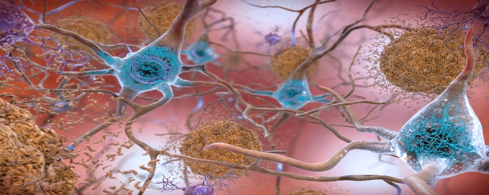 Alzheimer. Studiati gli effetti della terapia innovativa con gamma t-ACS: miglioramento significativo dei disturbi di memoria e dell’alterazione dei circuiti corticali cerebrali